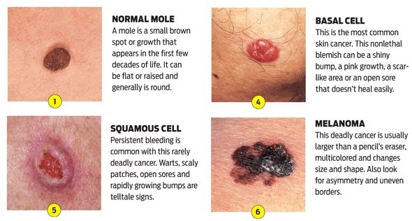 Skin Cancer – Know the Facts