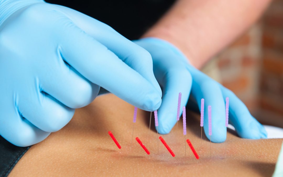 Major Indicators Of The Need Of Dry Needling Metro State Financial